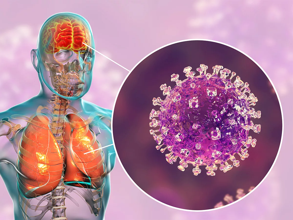 Nipah Virus Infection